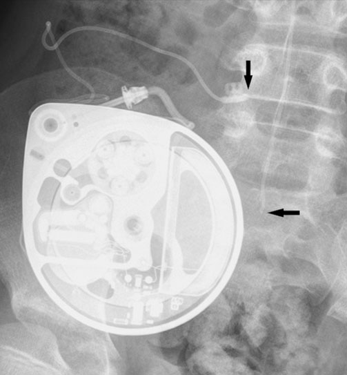 Intrathecal Pump Placement