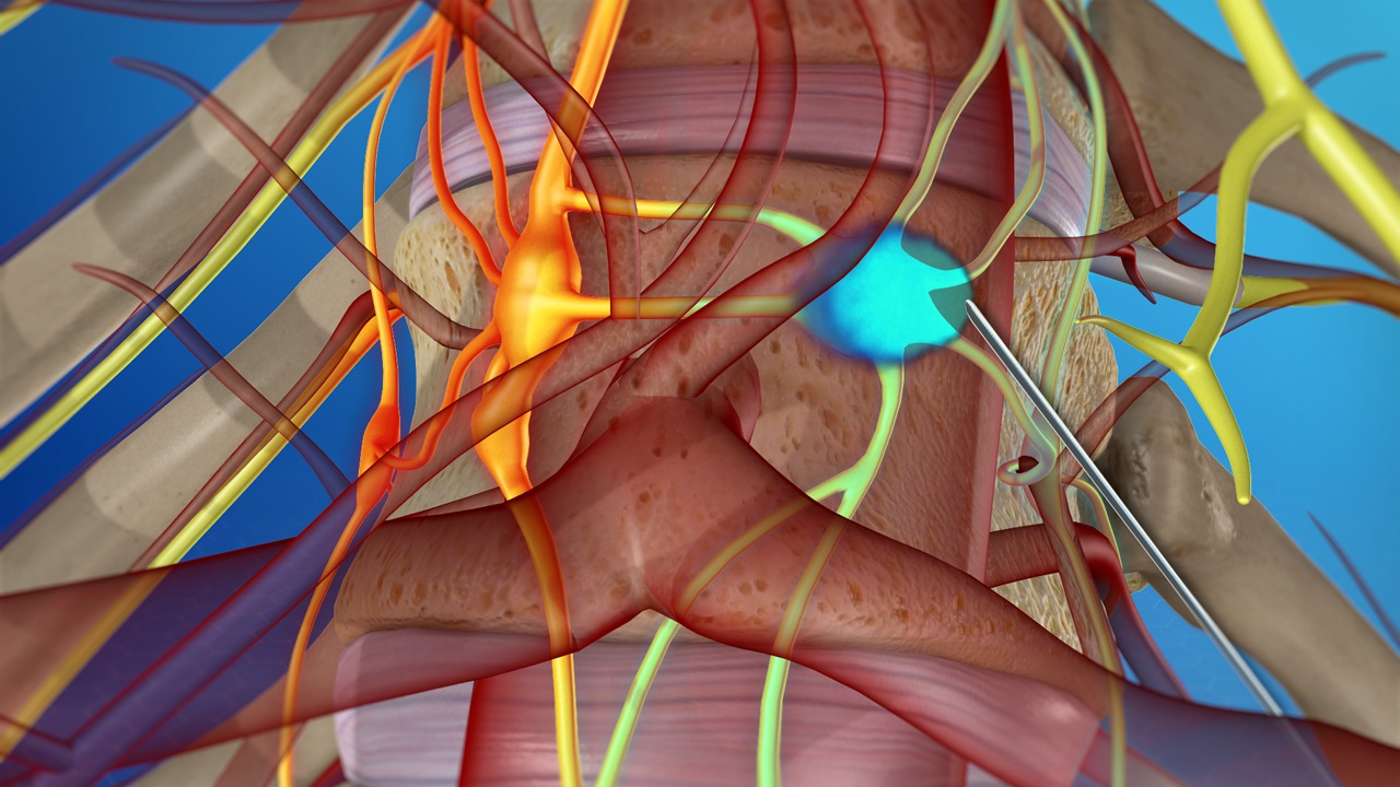 Chronic back pain Cape town